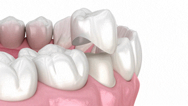 Dental Crowns East Longmeadow Dental Cosmetic Dentist MA