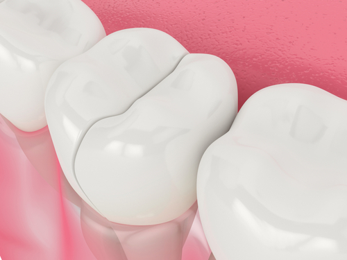 Do You Offer Dental Bonding east Longmeadow Dental in MA