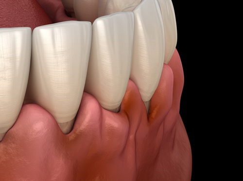 Gum Disease Treatment East Longmeadow Dental Periodontist in MA