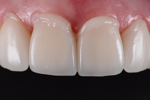 How Long Do Porcelain Veneers Last East Longmeadow Dental