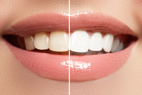 Teeth Whitening East Longmeadow Dental Cosmetic Dentistry in MA
