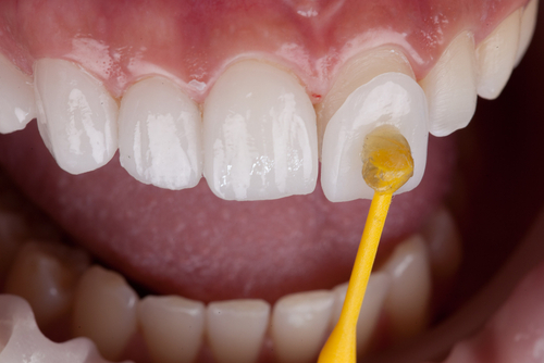 What are Veneers East Longmeadow Dental Veneers in MA