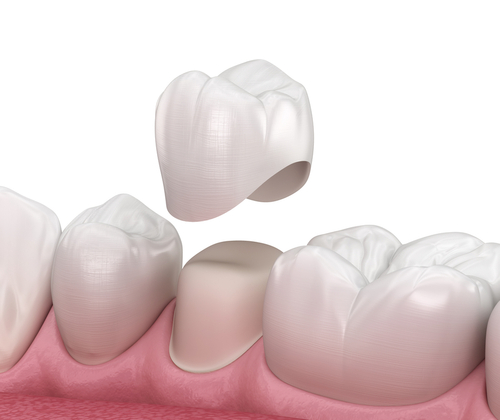 What is a Dental Crown East Longmeadow Dental in MA