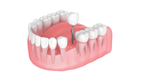 What is a Dental Implant East Longmeadow Dental in MA