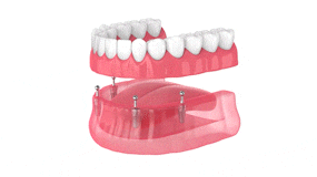 Full & Partial Dentures in East Longmeadow, MA