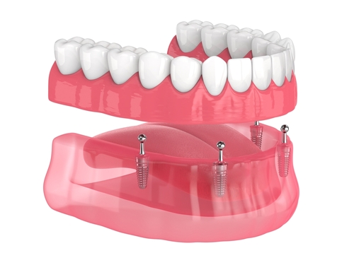 Full-Partial-Dentures-in-East-Longmeadow-MA