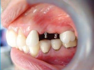 Mini_Dental_Implants_in_East_Longmeadow__MA