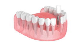 Dental Implants in East Longmeadow, MA