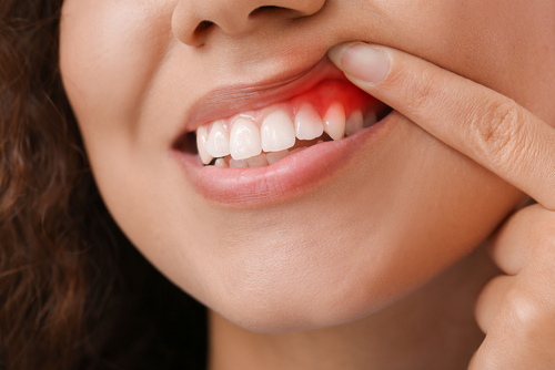 Gum Disease Treatment in Springfield, MA | Periodontal Disease