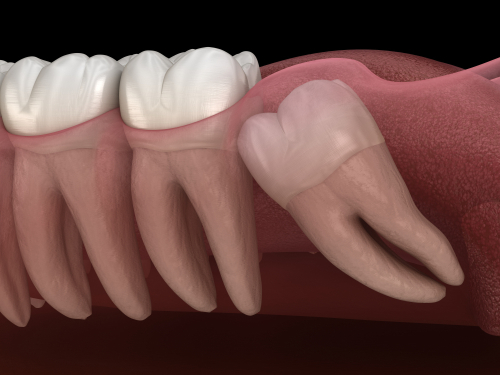 Wisdom Teeth in Springfield, MA | Tooth Extraction | Dr. Zirakian