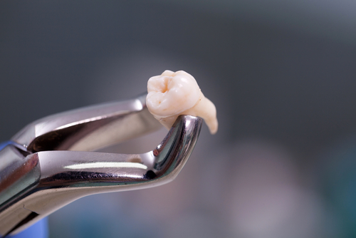 Tooth Extraction in Springfield, MA | Schedule a Free Consultation