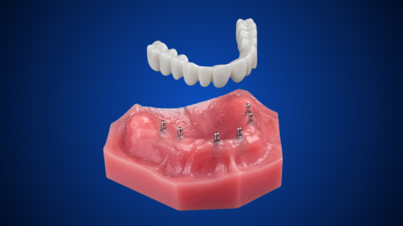 Alternatives to Dentures in East Longmeadow, MA | Dental Implants