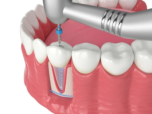 Root Canals in Springfield, MA | Book a Complimentary Exam