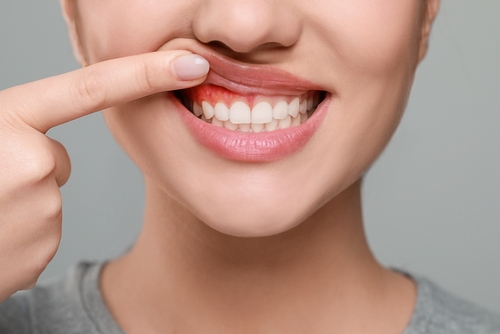 Signs of Gum Disease | Periodontal Treatment in Springfield, MA