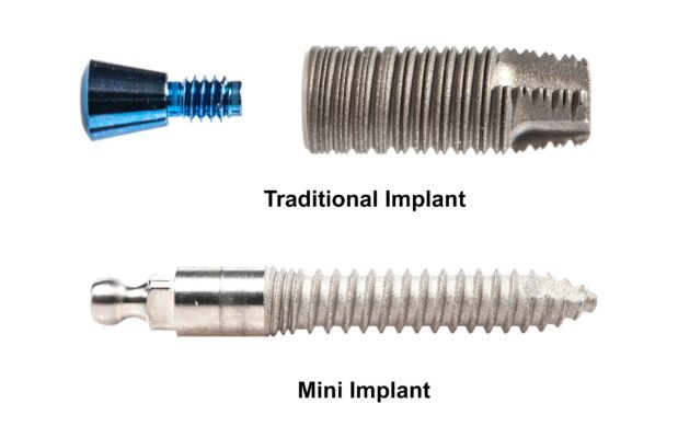 Mini Dental Implants Cost in MA | Mini Dental Implants vs Traditional Dental Implants