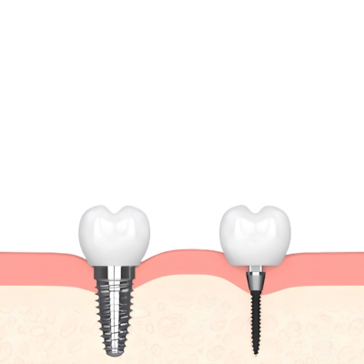 Mini Implants vs. Traditional Implants in East Longmeadow, MA