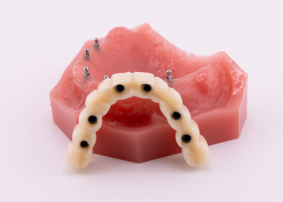 Semi Permanent Dentures in East Longmeadow, MA | Book a Free Consultation