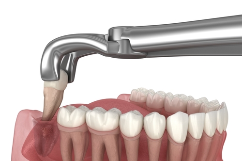 Dental Extraction in East Longmeadow, MA | Free Consultations
