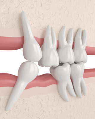 Knocked-Out Tooth in Springfield, MA | Free Consultations