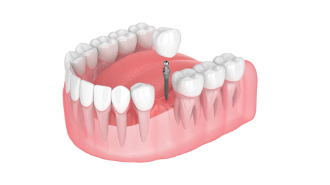 Dental Implants in Springfield, MA | Mini Dental Implants