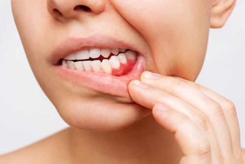 Reversing Gum Disease in Springfield, MA | Free Consultations