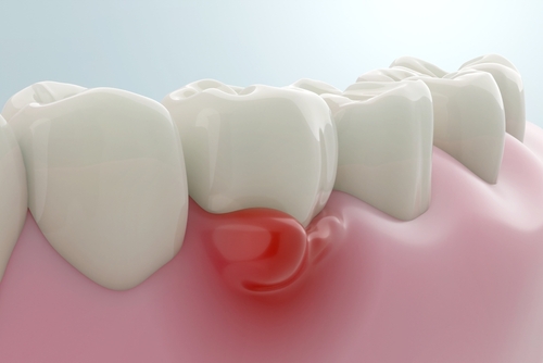 Reversing Gum Disease in Springfield, MA | Gum Disease Treatment