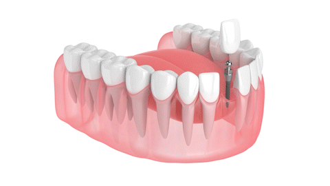 Dental Implants in Longmeadow, MA | Mini Implant Solutions