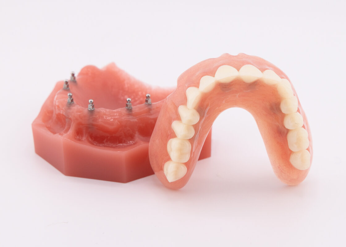 Affordable Implants and Dentures in Springfield, MA | Free Consults