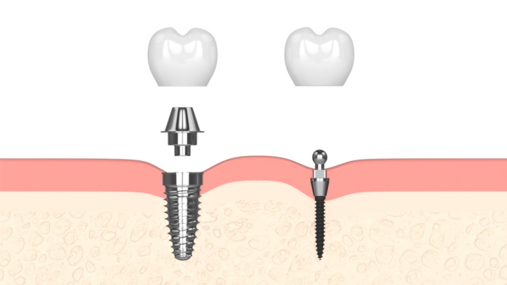 Best Implant Options in 2026 [Video Guide] | Free Consultations