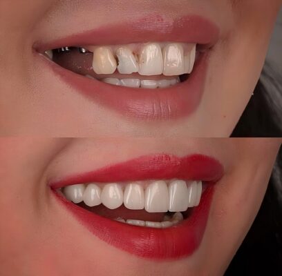 Smile Makeover in East Longmeadow, MA | Transform Your Smile Affordably
