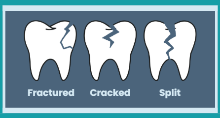 Broken Teeth in East Longmeadow, MA | How We Repair Your Smile