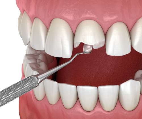 Broken Tooth in East Longmeadow, MA | Repair Your Tooth ASAP
