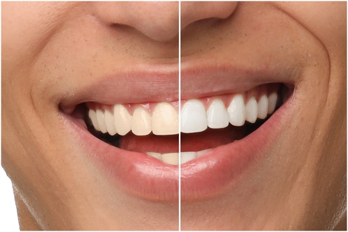 Teeth Whitening Cost in East Longmeadow, MA [Video Explanation]