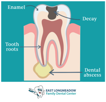 Tooth Infection Symptoms To Watch Out For | Find Fast and Effective Pain Relief in East Longmeadow